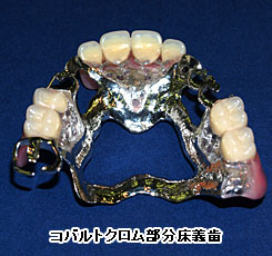 コバルトクロム部分床義歯
